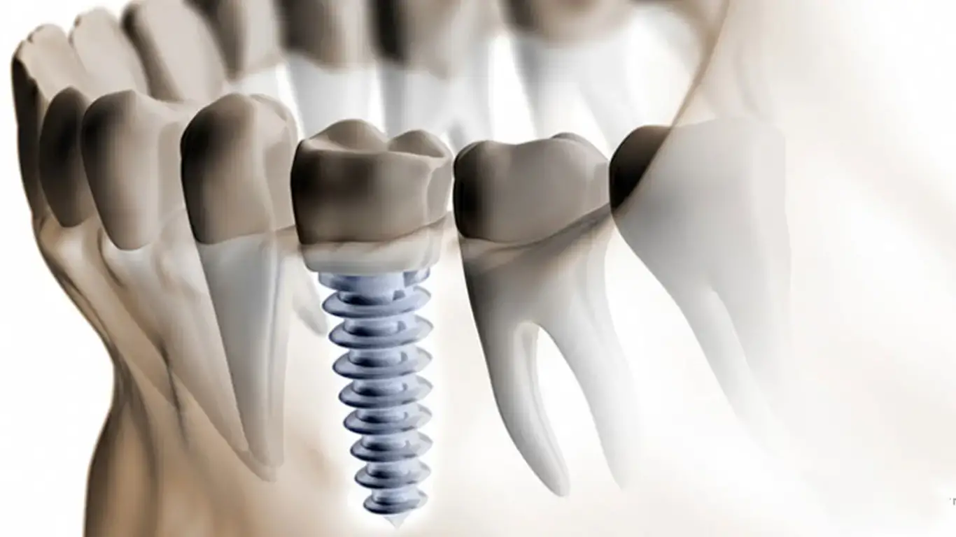 Преимущества профессиональных услуг имплантации зубов под ключ